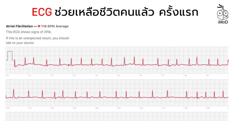 Ecg Feature Apple Watch Series 5 Save Life First Time