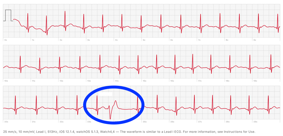 Apple Watch Detect Pvc Ecg And Useful For Deaf Customer 2