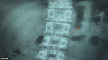 Accidentally Swallowed Airpods Keep Working