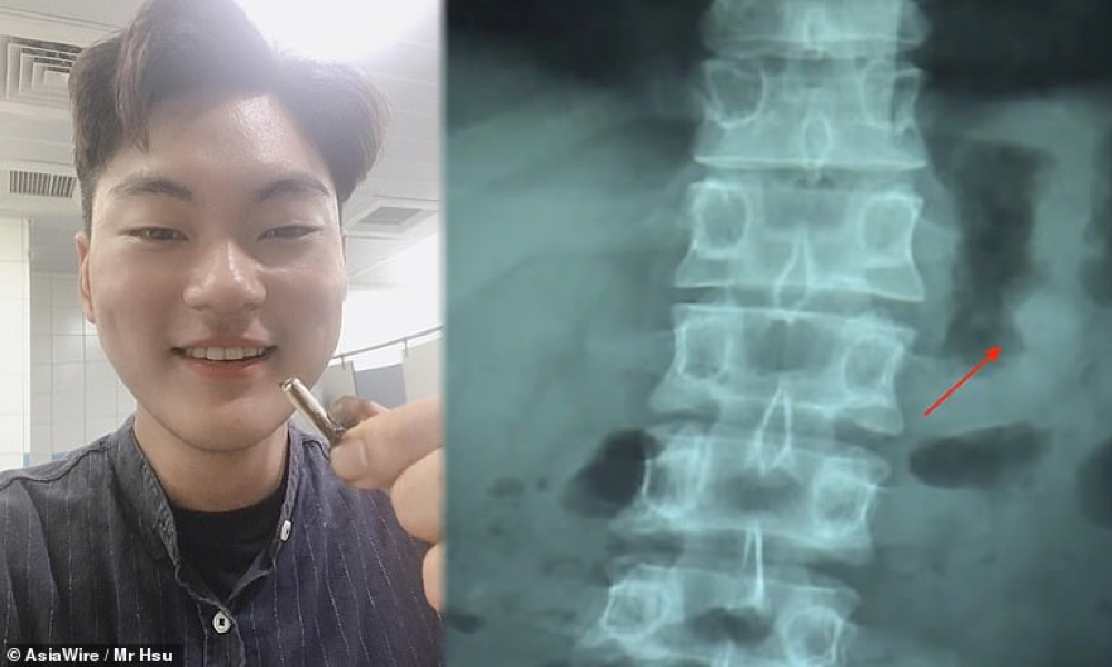 Accidentally Swallowed Airpods Keep Working Img 1